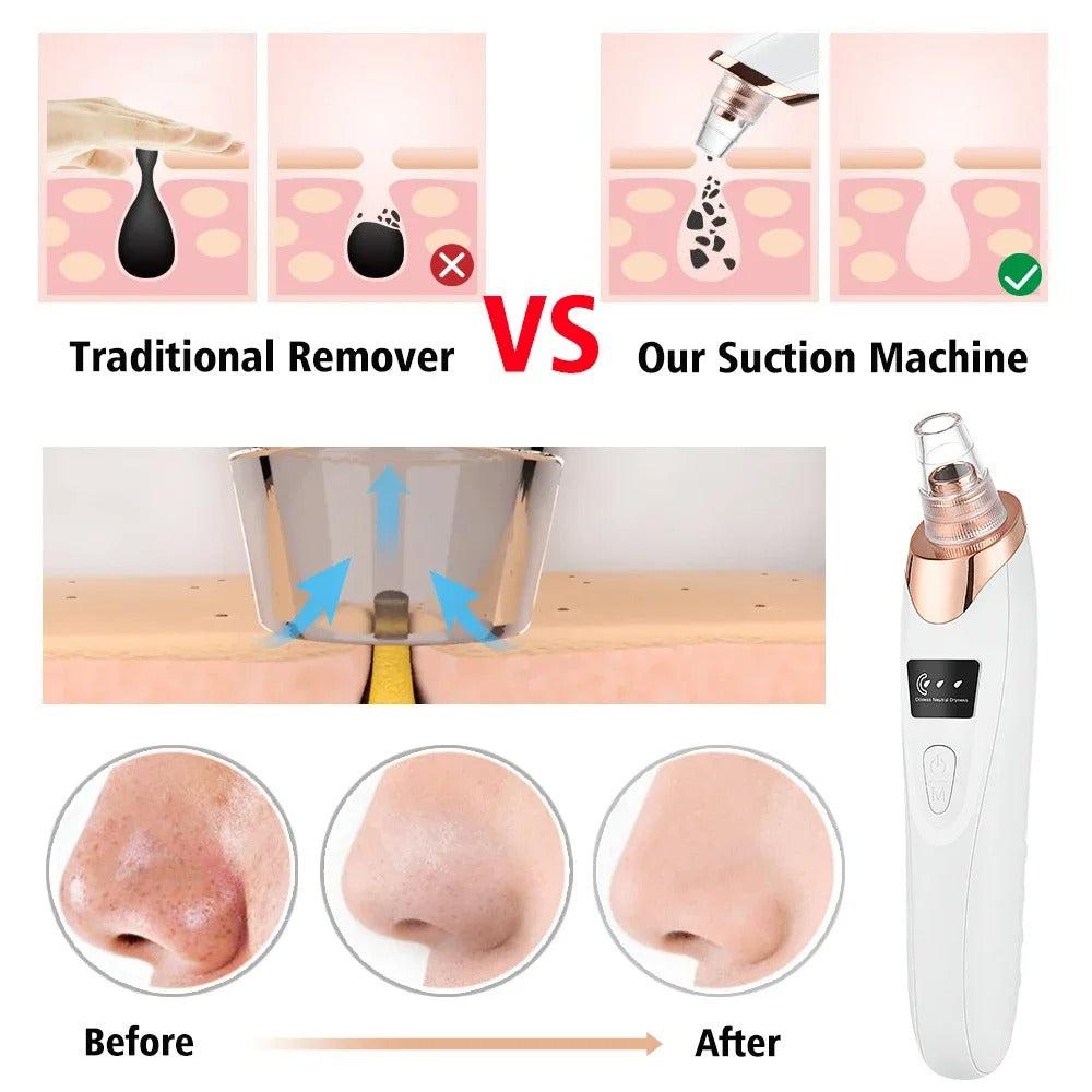 Electric Blackhead Remover, Vacuum Acne Cleaner, Black Spots Removal Device, Pore Cleaner Machine, Skin Care Tools, 5 Heads Suction Machine, Vacuum Electric Black Head Extractions Tool, Electric Facial Pore Cleaner, Exfoliating Beauty Device